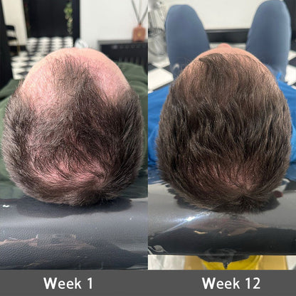 👨‍⚕️👨‍⚕️Official US Store | 🔥Livioram® Highly Effective Biotin & Rosemary Hair Growth Serum — Visibly fills thinning areas & receding hairlines (🔥 Limited-Time Offer, ⏳ Last 30 Minutes)