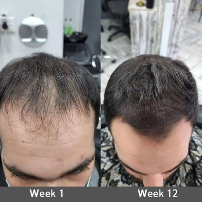 👨‍⚕️👨‍⚕️Official US Store | 🔥Livioram® Highly Effective Biotin & Rosemary Hair Growth Serum — Visibly fills thinning areas & receding hairlines (🔥 Limited-Time Offer, ⏳ Last 30 Minutes)